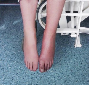 Reflex Sympathetic Dystrophy